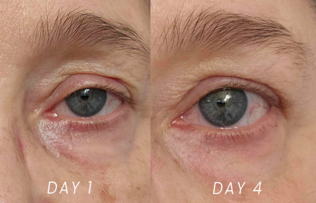 Annette's 4 day results from Eye Love It