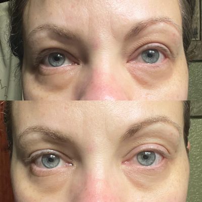 Charlene C. - These amazing results were 30 minutes apart! 🤯  I LOVE using our Arctic Rose Oil on my face but feel its too strong for around my eyes. This is product is a game changer for my skincare routine! It isn’t thick and I can apply my concealer over it! After seeing results from others in my team, I doubt I’ll even need the concealer anymore!! 🤞🏼  Where did my frown lines go? I’ve worked so hard on those for so long and had been warned about my scowl for YEARS! I feel robbed!