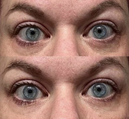 Jenn B. - As a 40 year old, busy single mom of 3- I feel like I always look sleep deprived and felt like the bags under my eyes were ever growing until I found Eye Love It!! Now I can look and feel refreshed with a very simple and easy application. These are my results from just two days! Can't wait to see the long-term results!